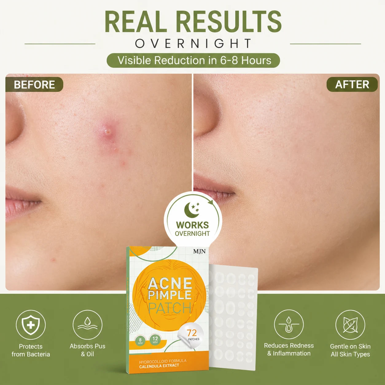 Acne Clearing Pimple Patches - Hydrocolloid Spot Patches (Pack of 2, 144 Patches)