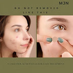 Acne Clearing Pimple Patches - Hydrocolloid Spot Patches (Pack of 2, 144 Patches)