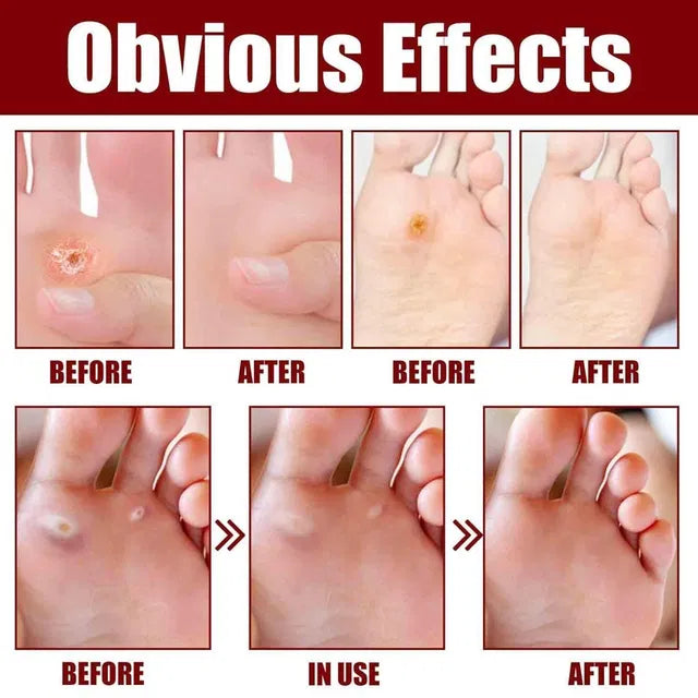 Foot Corn & Callus Removal Serum (30ml) – Fast-Acting Liquid Treatment for Cracked Heels & Permanent Pain Relief