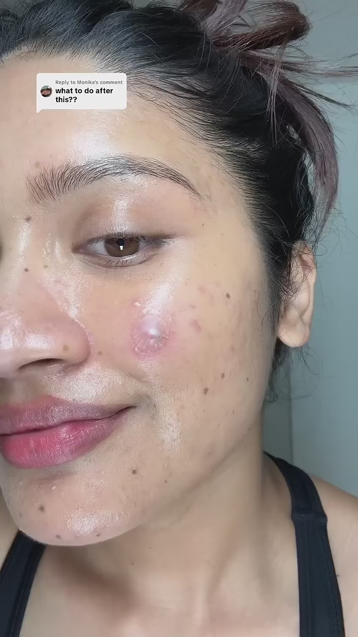 Acne Clearing Pimple Patches - Hydrocolloid Spot Patches (Pack of 2, 144 Patches)